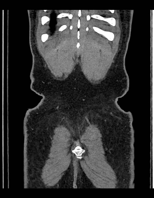 Adrenal myelolipoma - bilateral (Radiopaedia 74805-85810 Coronal C+ portal venous phase 51).jpg
