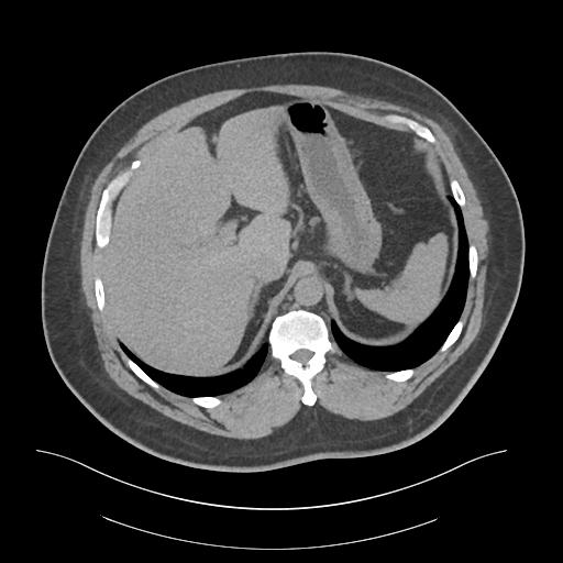 File:Adrenal vein sampling and adrenal nodular hyperplasia - Conn syndrome (Radiopaedia 30561-31337 Axial non-contrast 15).jpg