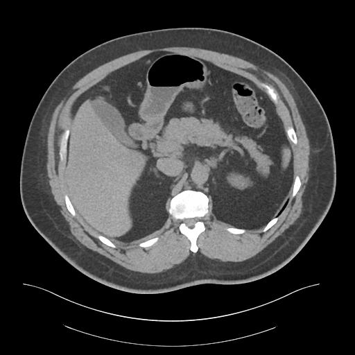 File:Adrenal vein sampling and adrenal nodular hyperplasia - Conn syndrome (Radiopaedia 30561-31337 Axial non-contrast 24).jpg
