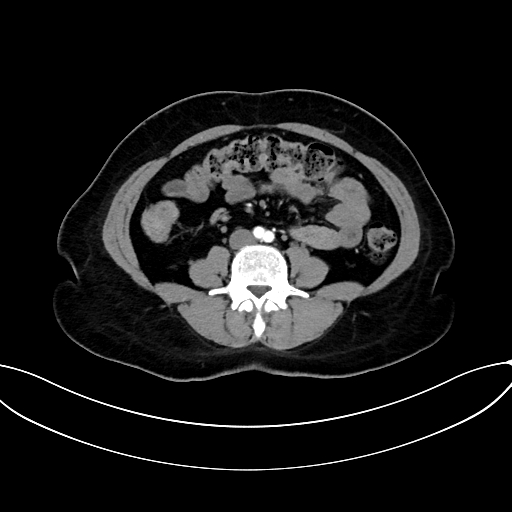 Adrenocortical carcinoma (Radiopaedia 87281-103569 Axial C+ arterial phase 52).jpg