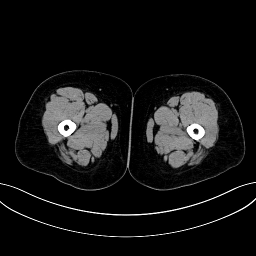 Adrenocortical carcinoma (Radiopaedia 87281-103569 Axial non-contrast 106).jpg