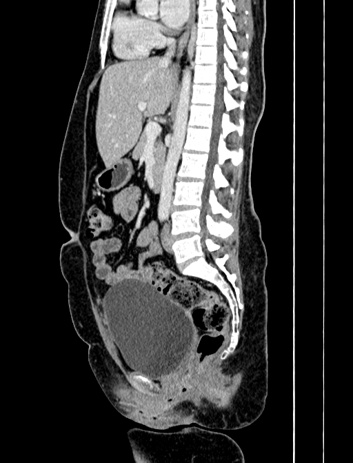 Adrenocortical carcinoma (Radiopaedia 87281-103569 Sagittal C+ portal venous phase 153).jpg