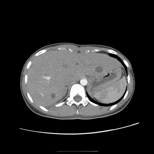 Adult polycystic kidney disease (Radiopaedia 48845-53876 Axial renal cortical phase 4).jpg