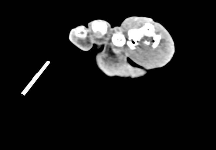 Advanced osteomyelitis due to open metatarsal fracture (Radiopaedia 83891-99095 Axial non-contrast 51).jpg