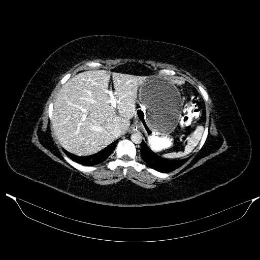 Afferent loop syndrome - secondary to incarcerated trocar site hernia (Radiopaedia 82959-97305 Axial C+ portal venous phase 47).jpg