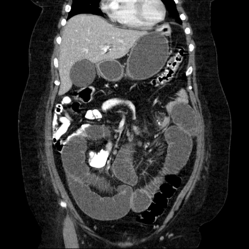 File:Afferent loop syndrome - secondary to incarcerated trocar site hernia (Radiopaedia 82959-97305 Coronal C+ portal venous phase 59).jpg