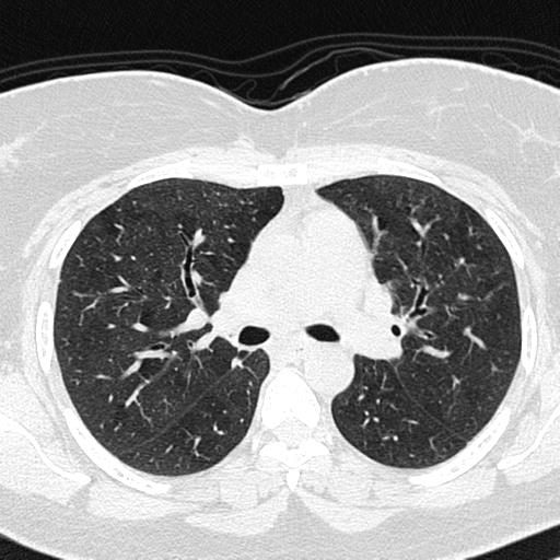 Air trapping in small airway disease (Radiopaedia 61685-69694 Axial lung window 70).jpg