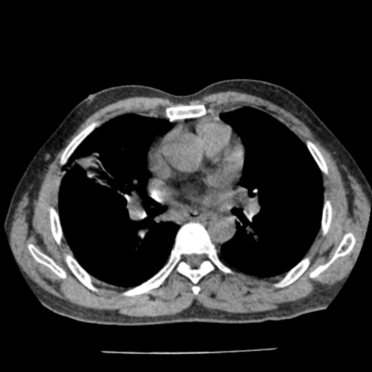Airway foreign body in adult (Radiopaedia 85907-101779 Axial liver window 88).jpg
