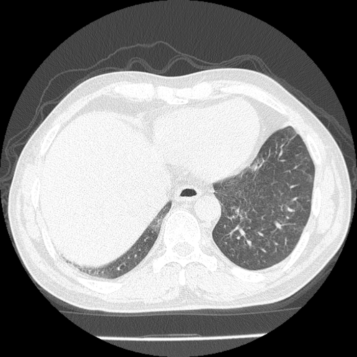 Airway foreign body in adult (Radiopaedia 85907-101779 Axial lung window 151).jpg