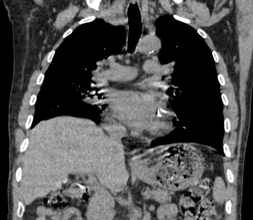 Airway foreign body in adult (Radiopaedia 85907-101779 Coronal liver window 128).jpg