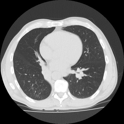Allergic bronchopulmonary aspergillosis (ABPA) (Radiopaedia 60594-68313 Axial lung window 37).jpg