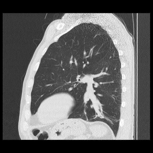 Allergic bronchopulmonary aspergillosis (ABPA) (Radiopaedia 60594-68313 Sagittal lung window 18).jpg