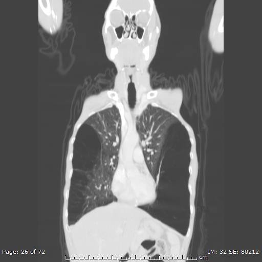 Alpha-1-antitrypsin deficiency (Radiopaedia 50561-55987 Coronal lung window 24).jpg