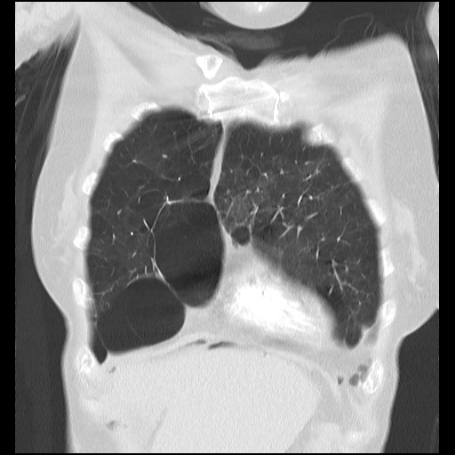 File:Alpha-1-antitrypsin deficiency (Radiopaedia 64893-73840 Coronal lung window 6).jpg