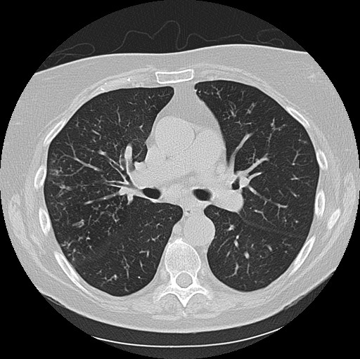 Alpha-1-antitrypsin deficiency (Radiopaedia 72058-82557 Axial lung window 32).jpg