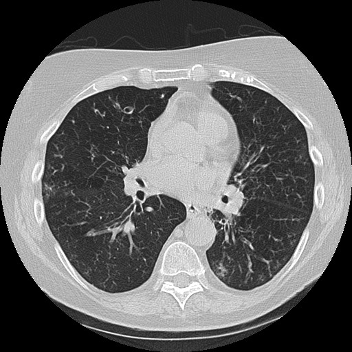 Alpha-1-antitrypsin deficiency (Radiopaedia 72058-82557 Axial lung window 40).jpg