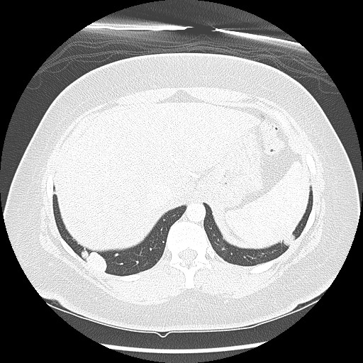 Alveolar soft part sarcoma - right leg (Radiopaedia 59432-67091 Axial lung window 101).jpg