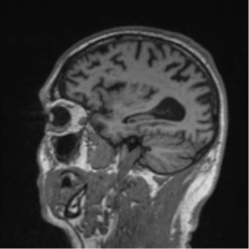 Alzheimer's disease- with Gerstmann syndrome and dressing apraxia (Radiopaedia 54882-61150 Sagittal T1 52).png