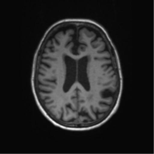 Alzheimer's disease (Radiopaedia 42658-45802 Axial T1 62).png