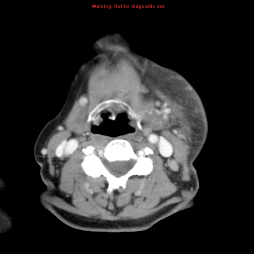 Ameloblastoma (Radiopaedia 27437-27631 A 56).jpg