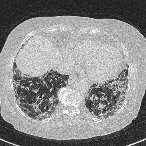 Amiodarone-induced pulmonary fibrosis (Radiopaedia 82355-96460 Axial lung window 52).jpg