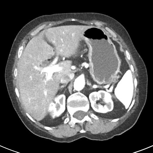 Ampullary adenocarcinoma (Radiopaedia 34013-35237 B 22).png