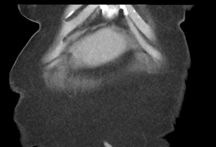 Ampullary adenocarcinoma (Radiopaedia 34013-35241 Coronal 6).png