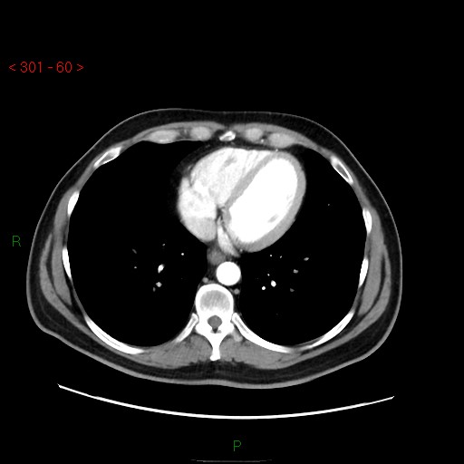 File:Ampullary carcinoma (Radiopaedia 56396-63056 B 6).jpg
