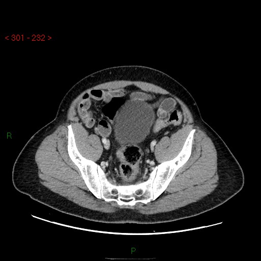 Ampullary carcinoma (Radiopaedia 56396-63056 C 82).jpg