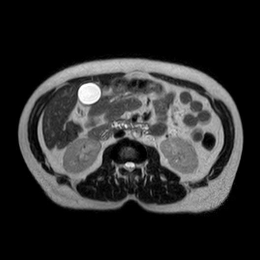 File:Ampullary tumor (Radiopaedia 27294-27479 T2 1).jpg