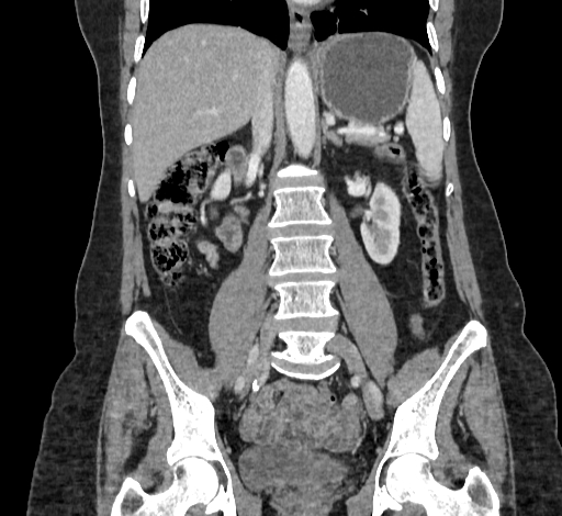 Ampullary tumor (Radiopaedia 60333-67998 B 45).jpg