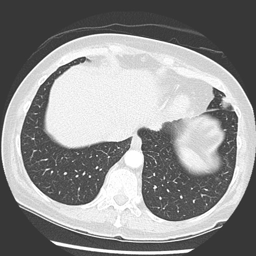 Amyloidosis - bronchial and diffuse nodular pulmonary involvement (Radiopaedia 60156-67745 Axial lung window 69).jpg