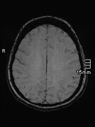 Amyotrophic lateral sclerosis (Radiopaedia 70821-81017 Axial SWI 38).jpg