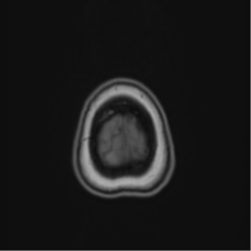 Anaplastic astroblastoma (Radiopaedia 55666-62194 Axial T1 71).png