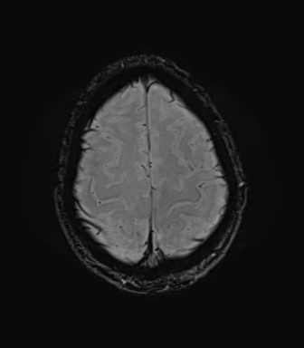 File:Anaplastic astrocytoma IDH mutant (Radiopaedia 50046-55341 Axial SWI 74).png