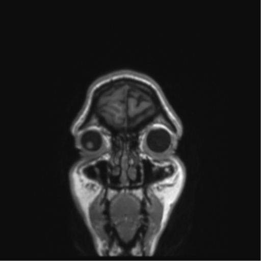 Anaplastic astrocytoma IDH mutant (Radiopaedia 50046-55341 Coronal T1 57).png