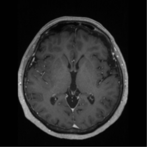 File:Anaplastic astrocytoma IDH wild-type (pseudoprogression) (Radiopaedia 42209-45276 Axial T1 C+ 77).png