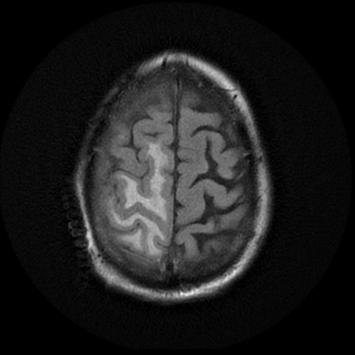 File:Anaplastic meningioma with recurrence (Radiopaedia 34452-35791 Axial FLAIR 19).png