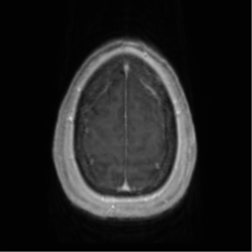 Anaplastic oligodendroglioma (Radiopaedia 83500-98599 Axial T1 C+ 67).png