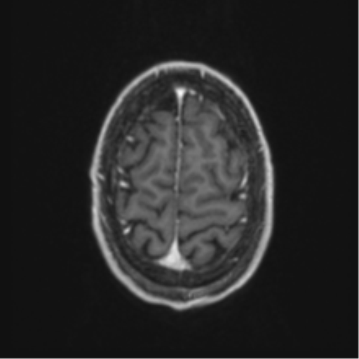 Anaplastic oligodendroglioma with skull fracture (Radiopaedia 74831-85845 Axial T1 C+ fat sat 58).png