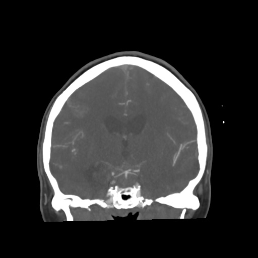 Aneursym related subarachnoid hemorrhage with hydrocephalus (Radiopaedia 45105-49084 B 40).jpg