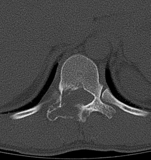 Aneurysmal bone cyst T11 (Radiopaedia 29294-29721 Axial bone window 42).jpg