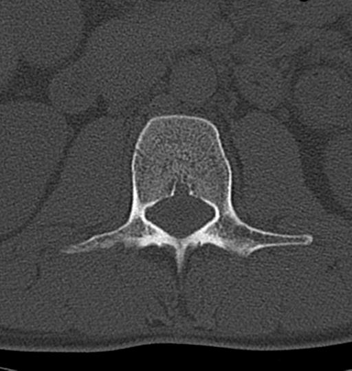 Aneurysmal bone cyst T11 (Radiopaedia 29294-29721 Axial bone window 76).jpg