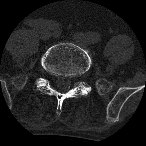 Ankylosing spondylitis complicated by fracture-dislocation (Radiopaedia 33583-34674 Axial non-contrast 135).jpg