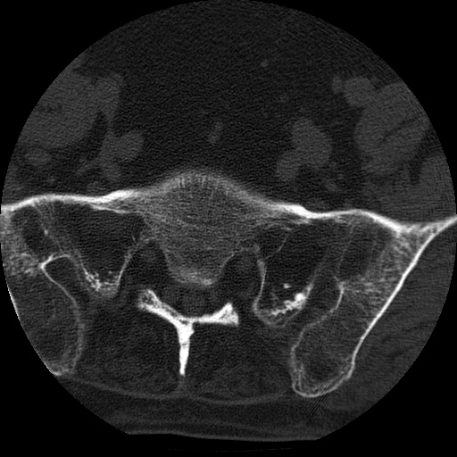 File:Ankylosing spondylitis complicated by fracture-dislocation (Radiopaedia 33583-34674 Axial non-contrast 159).jpg