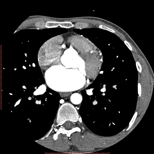 File:Anomalous left coronary artery from the pulmonary artery (ALCAPA) (Radiopaedia 70148-80181 A 150).jpg