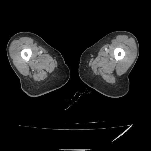 File:Anorectal carcinoma (Radiopaedia 44413-48064 A 76).jpg