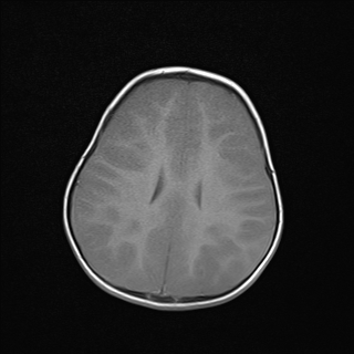 File:Anoxic brain injury (Radiopaedia 79165-92139 Axial T1 19).jpg