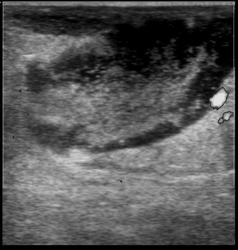File:Anterior abdominal wall abscess (Radiopaedia 17732-17480 C 1).jpg