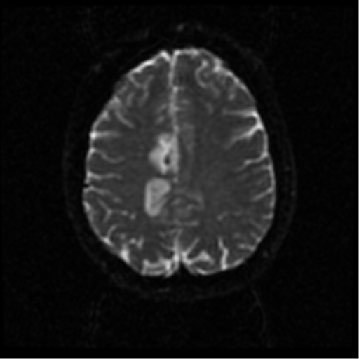 File:Anterior cerebral artery territory infarct (Radiopaedia 39327-41584 Axial DWI 44).png